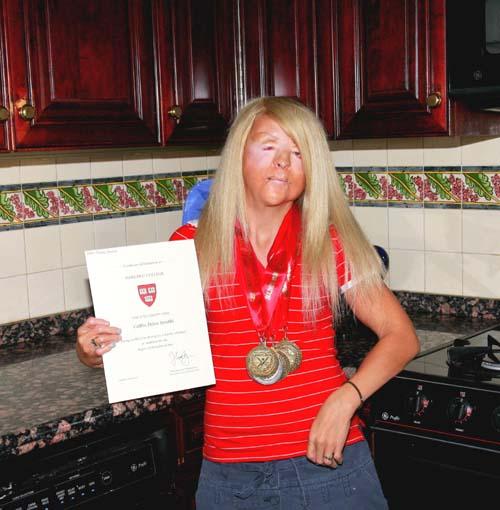 Gerritsen girl an Ivy League success – Legally blind, hearing-impaired kid ski champ will go to Harvard this fall