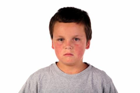 Brooklyn ground zero in measles outbreak