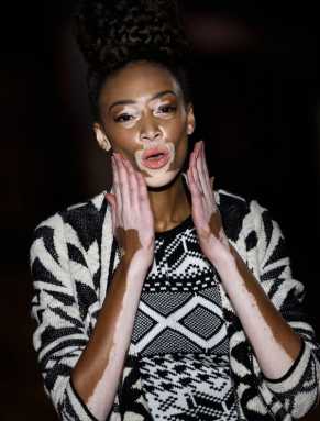 Vitiligo veritas