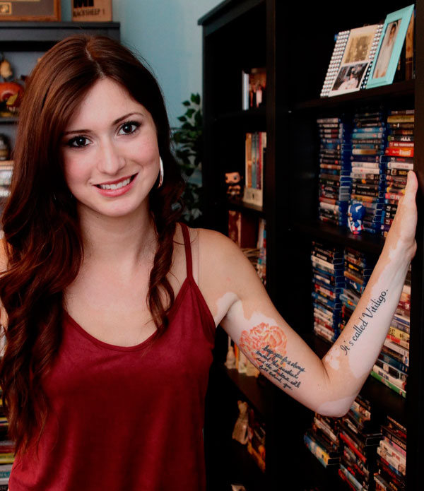 Tattoo announces Dyker woman’s skin disorder