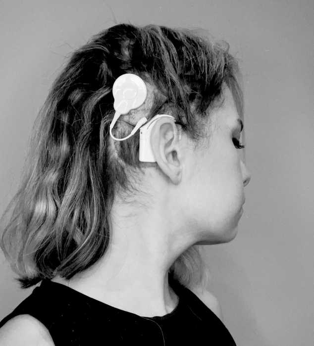 leanna scaglione with cochlear implant